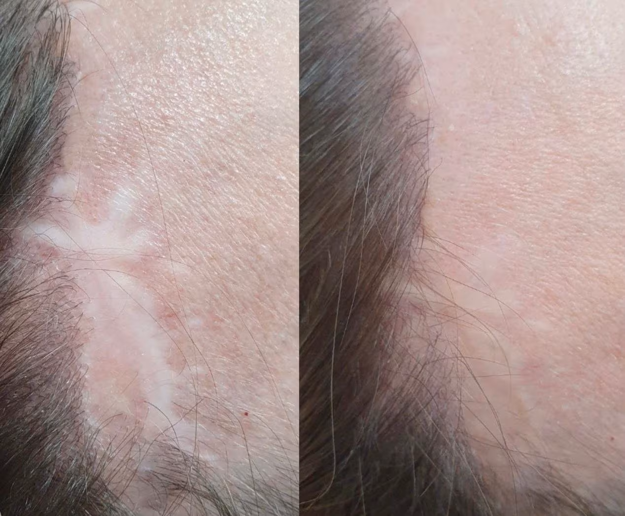 Scalp scar camouflage before and after with micropigmentation